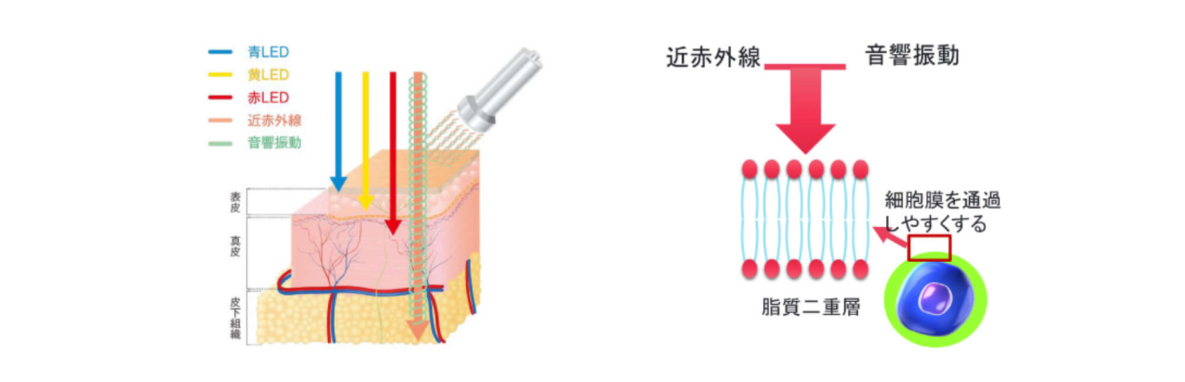 音響振動学に基づいた振動による治療